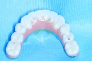 Implant all on 6
