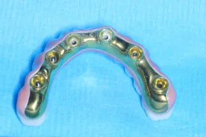 Bottom of all-on-6 Implants